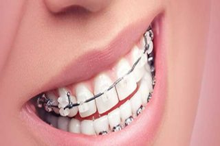 ارتودنسی دندانها