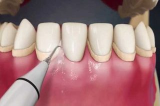 جرم گیری دندان 1