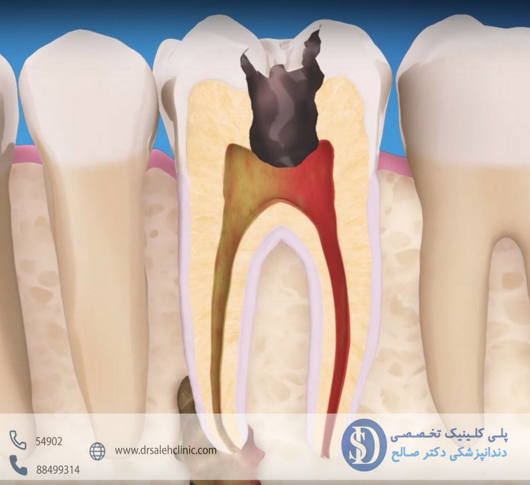 درمان ریشه دندان در دندانپزشکی فاطمی 1