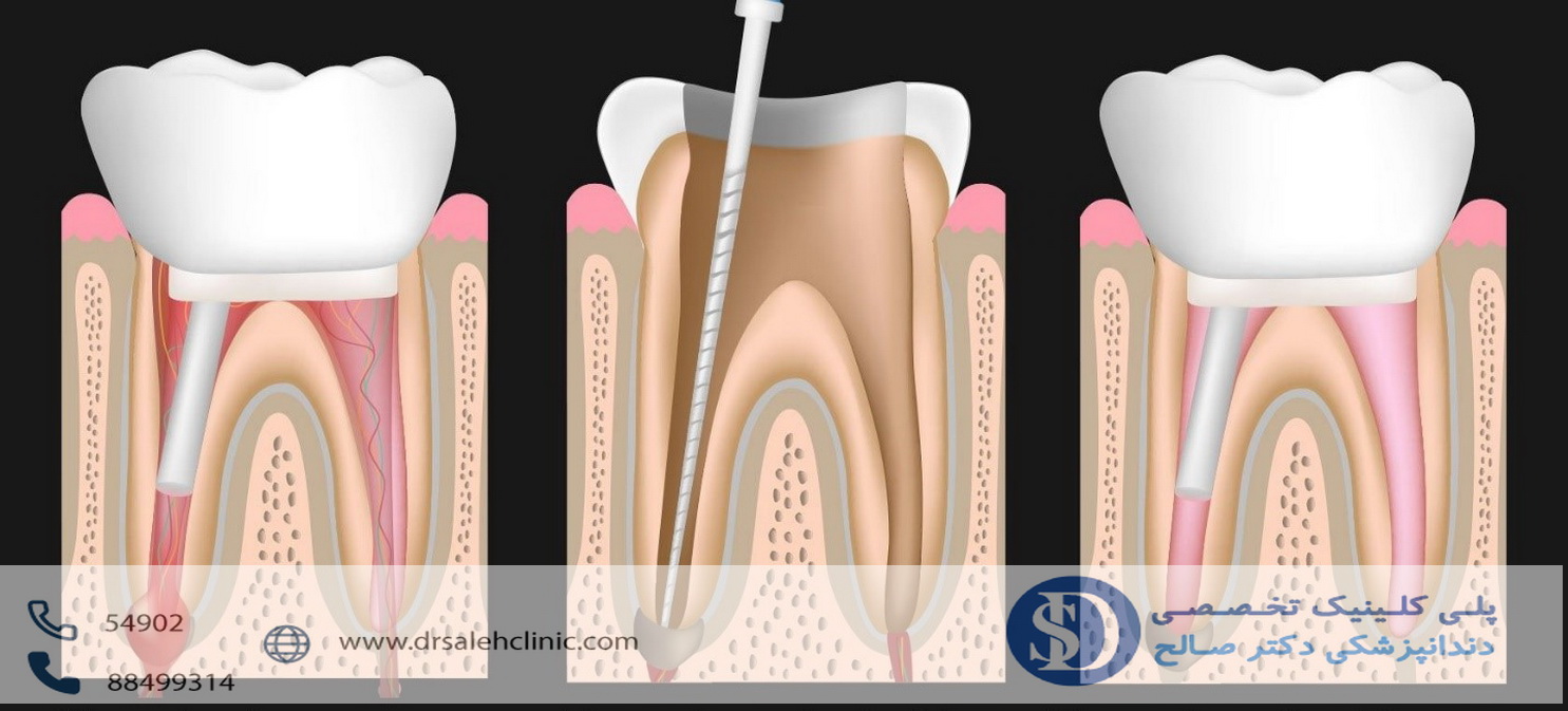 درمان ریشه دندان در دندانپزشکی فاطمی 3