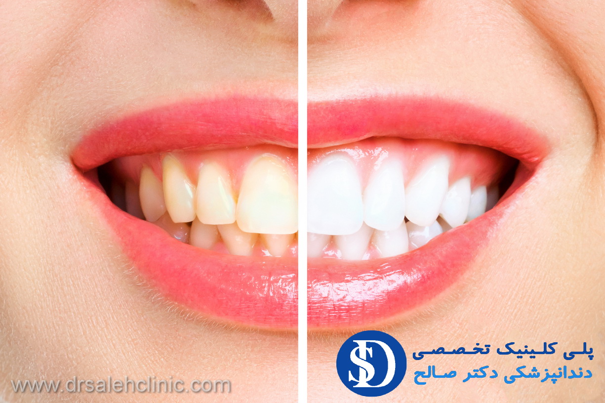 زیبایی دندان - ایمپلنت دندان
