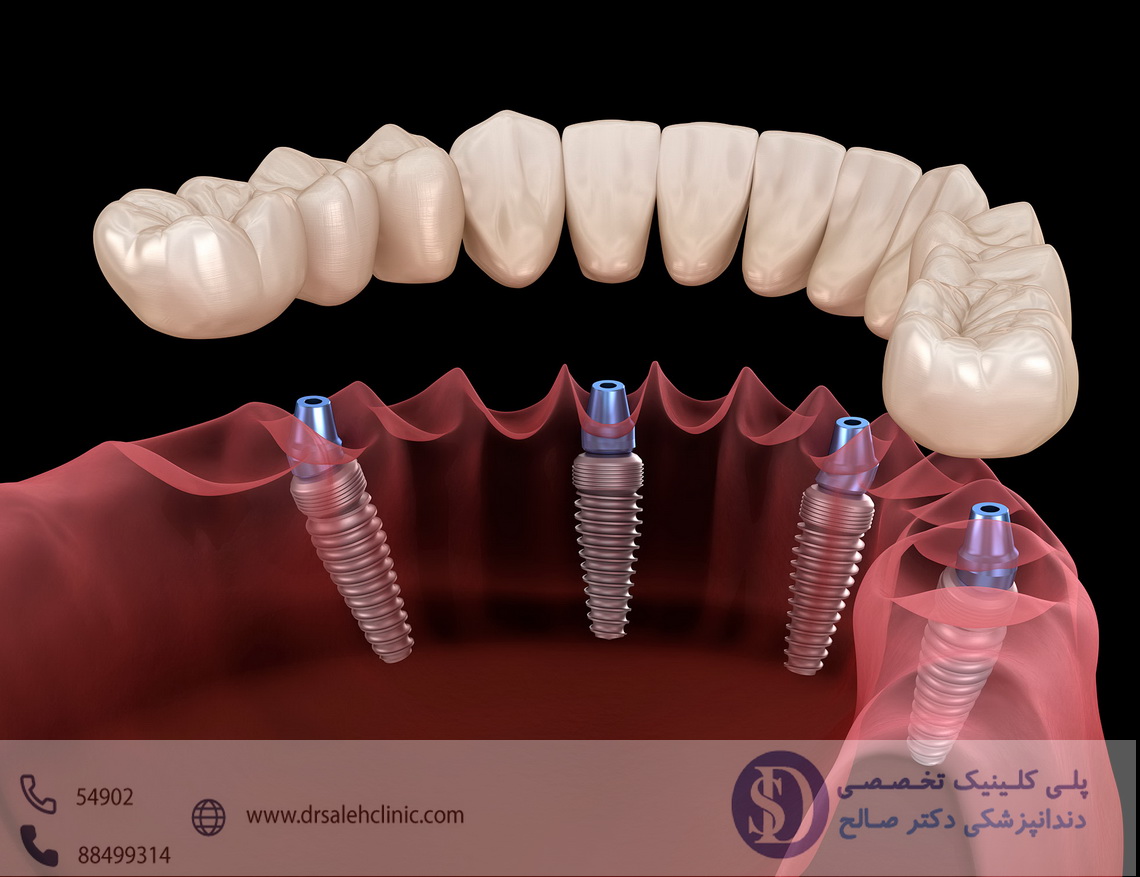 دندانپزشکی فاطمی - ایمپلنت دندان