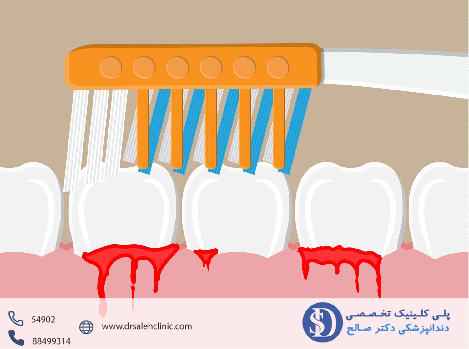 روش های درمان خونریزی لثه در دندانپزشکی فاطمی
