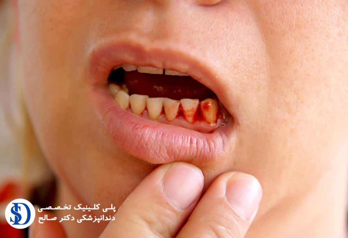 cause-and-treatment-of-gingival-bleeding-1200x822.jpg