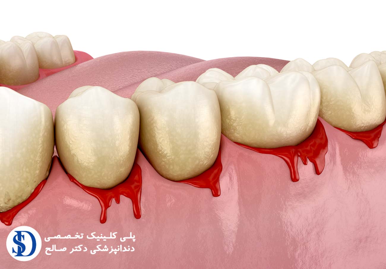 دندانپزشکی فاطمی- خونریزی لثه