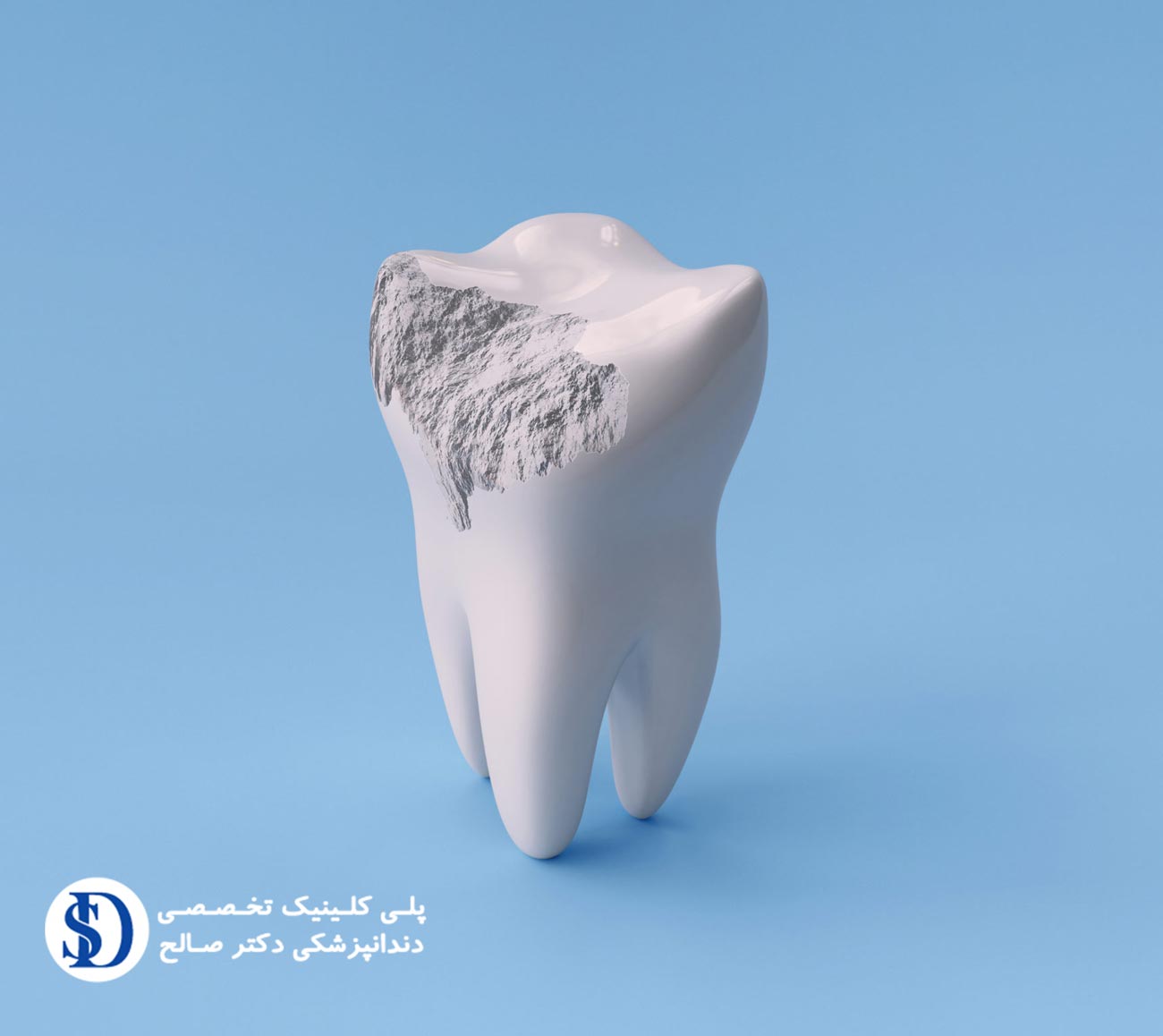 دندانپزشکی فاطمی-رفع فرسایش مینای دندان