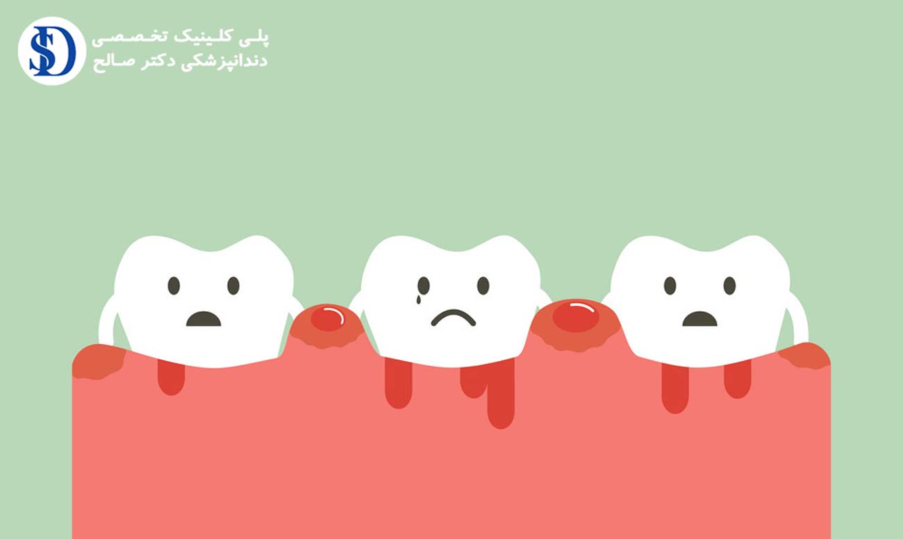 علت خونریزی لثه-دندانپزشکی فاطمی