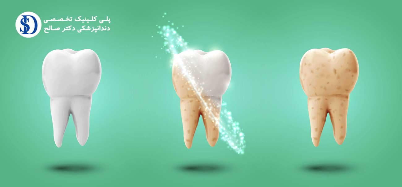 دندانپزشکی فاطمی-مینای دندان