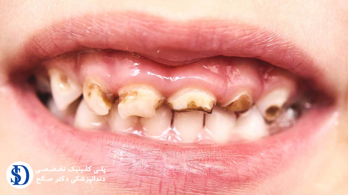 دندانپزشکی فاطمی برای رفع سیاهی روی دندان کودک