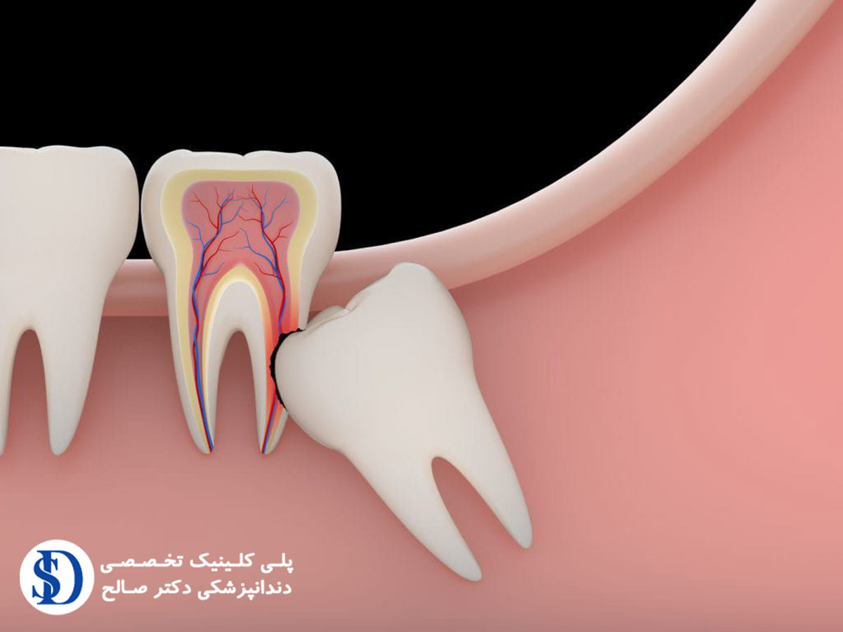 دندانپزشکی فاطمی-مشکلات دندان عقل نهفته