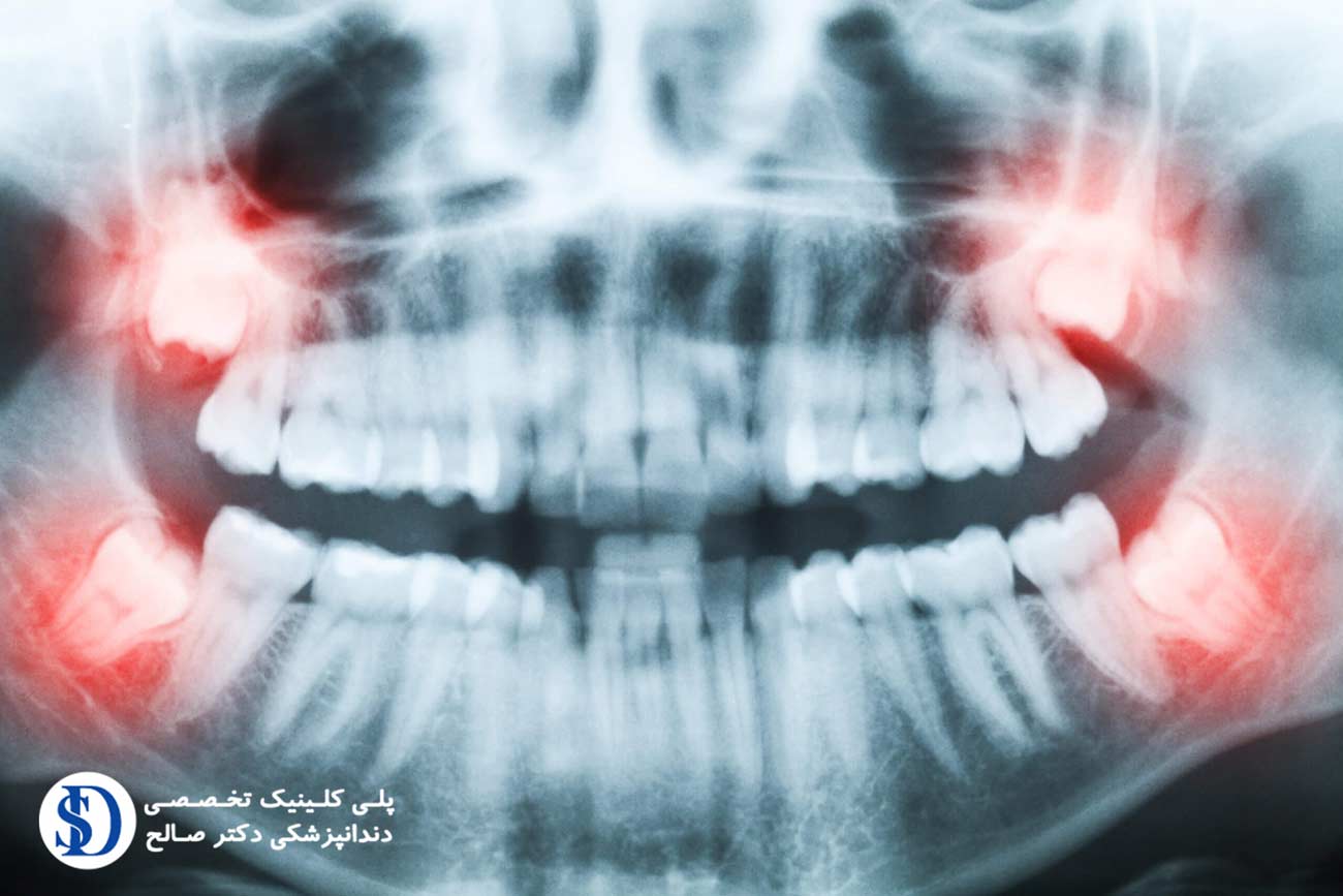دندانپزشکی فاطمی-علائم دندان عقل نهفته