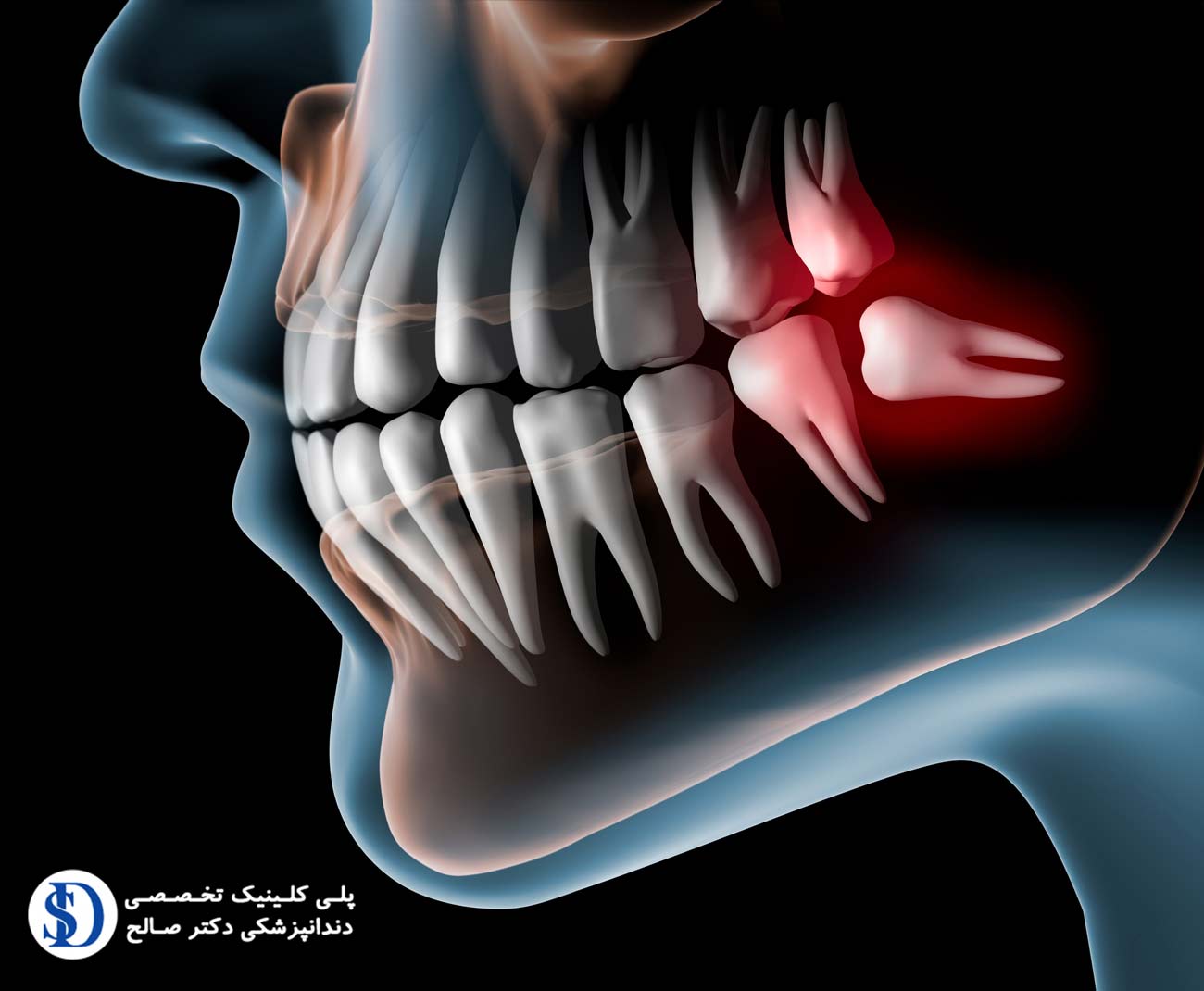 دندانپزشکی اقساطی-دندان عقل