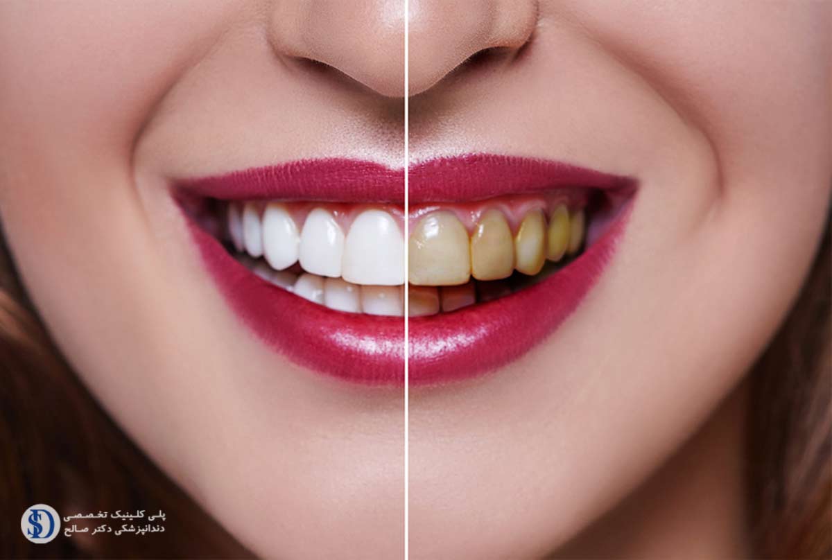 Dental-laminate-or-composite.jpg