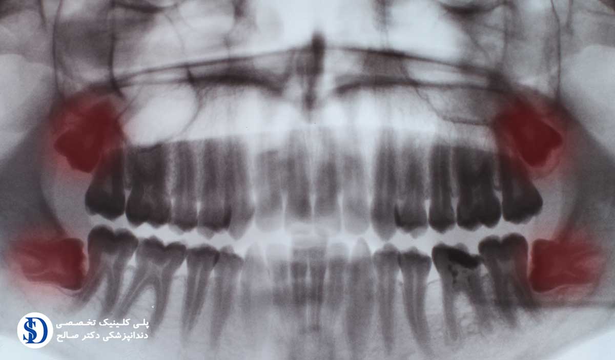 جراحی دندان عقل در دندانپزشکی فاطمی
