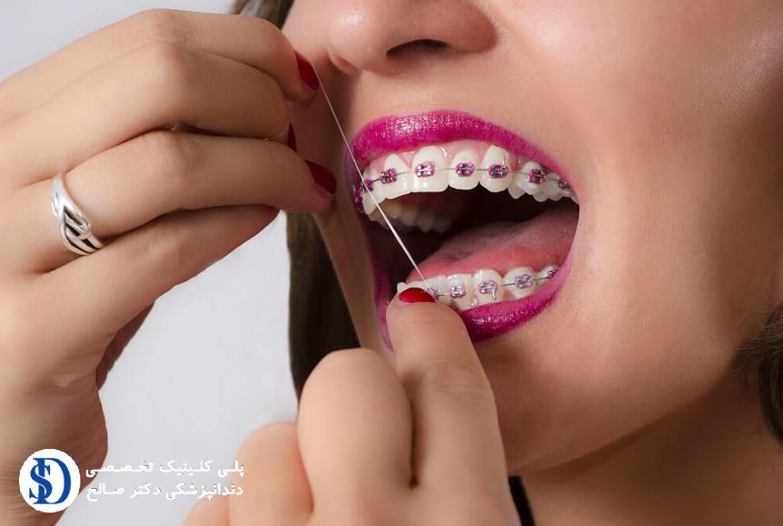 Does-orthodontics-cause-tooth-decay.jpg