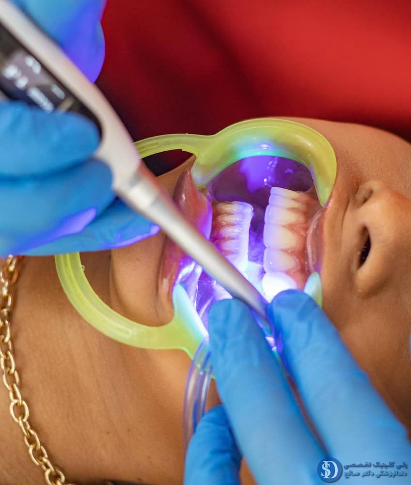 مراحل درمان ریشه دندان با لیزر در کلینیک دندانپزشکی دکتر صالح