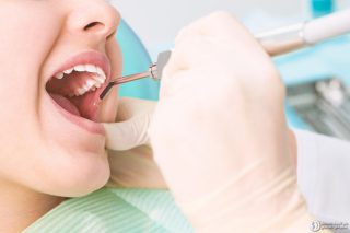 مزایای سیلانت دندان