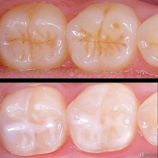 مراحل انجام سیلانت دندان