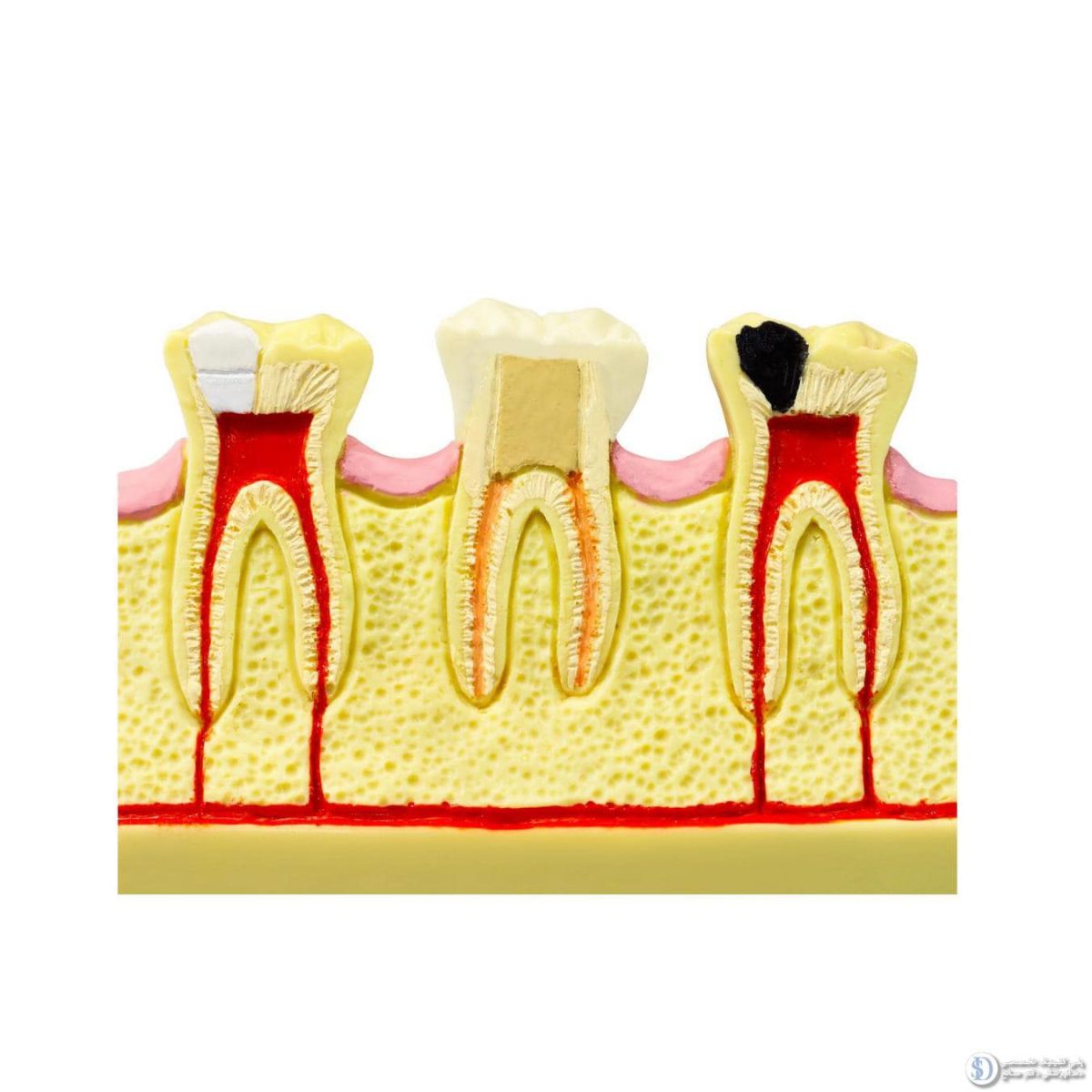 حفره دندان چیست