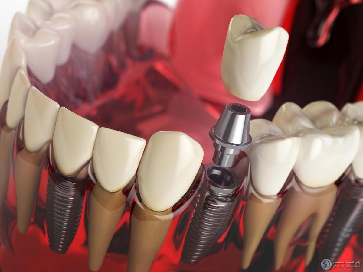 featuring-image-Dental-implants-with-different-materials-and-brands-drsalehclinic-1200x900.jpg
