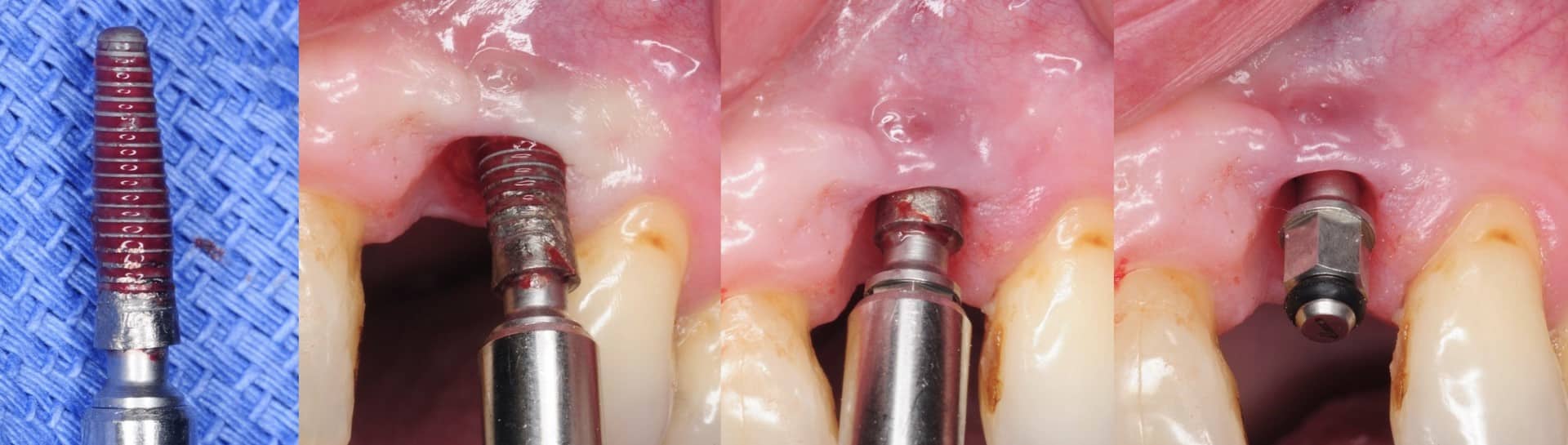علل عفونت ایمپلنت دندانی