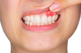 درمان عفونت ایمپلنت دندانی